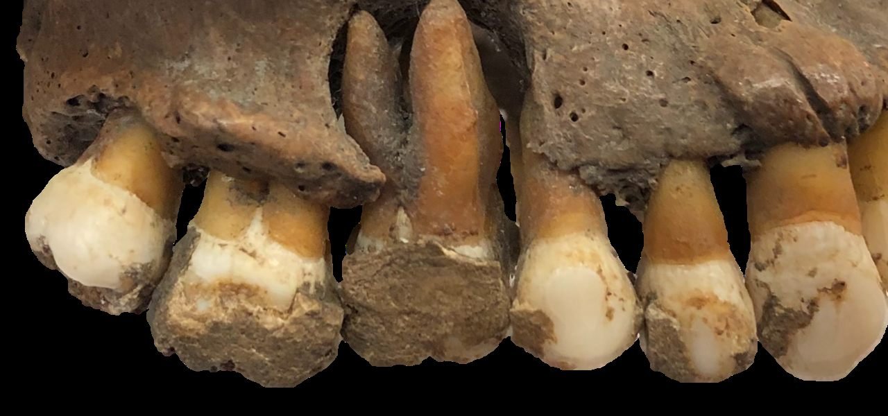 Cao răng trên mẫu hàm người trong ảnh tư liệu nghiên cứu