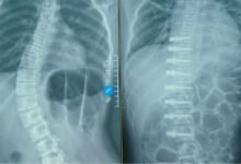Phim X-quang cột sống do Bệnh viện TWQĐ 108 công bố trong thông tin về ca phẫu thuật VBT