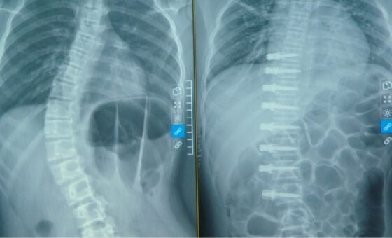 Phim X-quang cột sống do Bệnh viện TWQĐ 108 công bố trong thông tin về ca phẫu thuật VBT