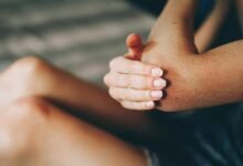 Bệnh nhân vảy nến chăm sóc vùng da tổn thương bong vảy và tìm hiểu hoạt chất pantethine kháng viêm